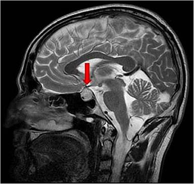 A Rare Case of Pituitary Melanoma Metastasis: A Dramatic and Prolonged Response to Dabrafenib-Trametinib Therapy